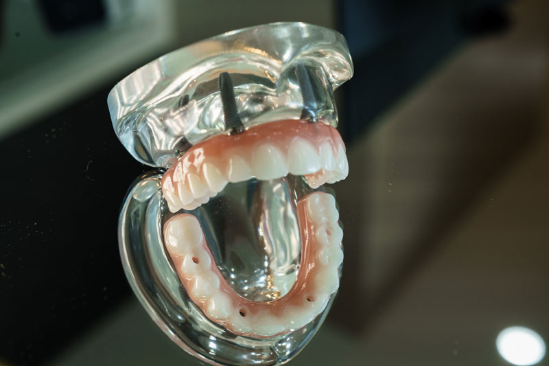 a full arch of teeth top and bottom on a model with the mouth open