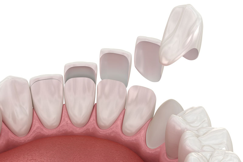 Transform Your Smile: The Benefits and Process of Porcelain Veneers in Murphy TX